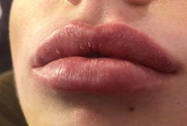 Lip Fillers are also known as lip injections, enhancement or augmentation and are used to add or restore volume to the lips. If your lips have lost definition over the years, or never had the fullness you would like, fillers can enhance the shape and volume of your lips for more definition.
